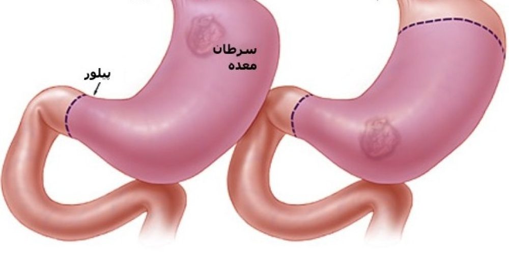 علایم و راه های درمان سرطان معده چیست سامانه سراسری زمات