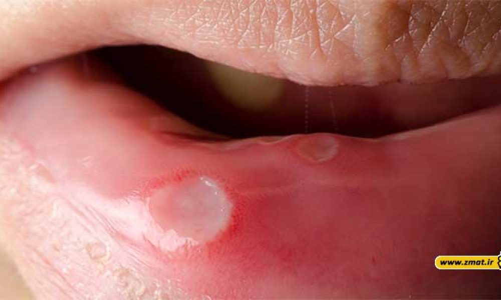 درمان آفت دهان با ۱۵ روش خانگی و گیاهی