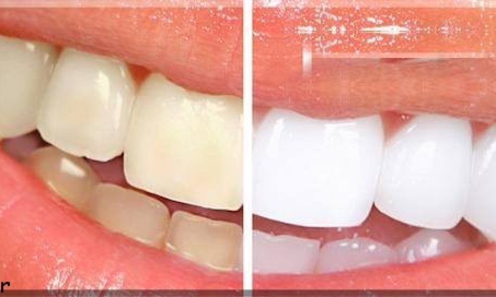 دانستنی های سفید کردن دندان