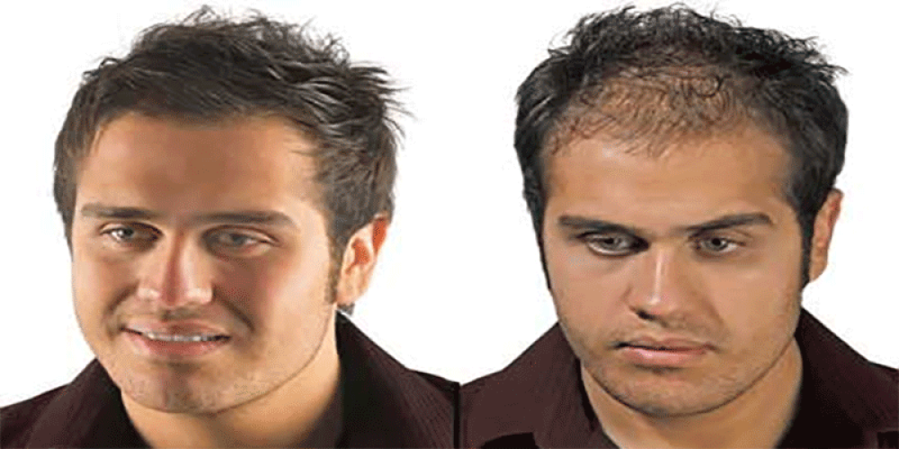 چگونگی رشد مجدد مو در یک نقطه طاس