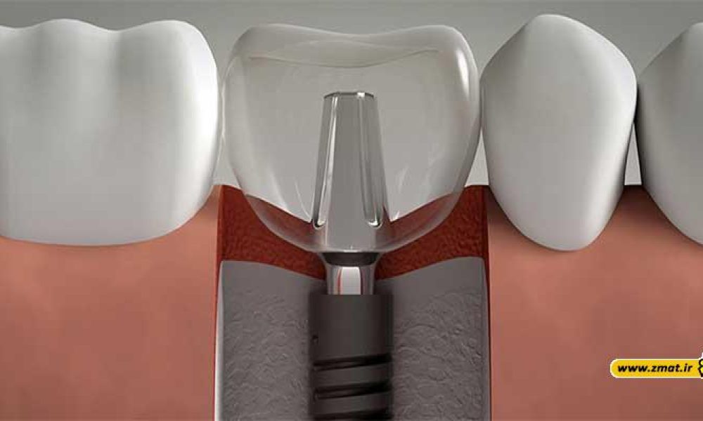 ایمپلنت دندان چیست و انواع ایمپلنت کدام اند؟
