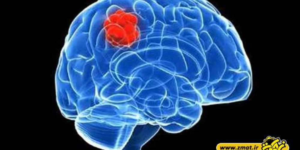 8 راه برای جلوگیری از سکته مغزی