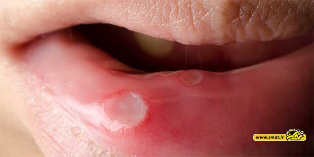 درمان آفت دهان با ۱۵ روش خانگی و گیاهی
