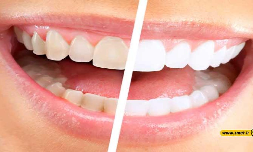 دلایل بدرنگی دندان ها چیست؟