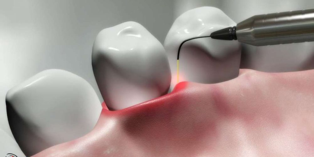 مزایا و معایب لیزر در دندانپزشکی