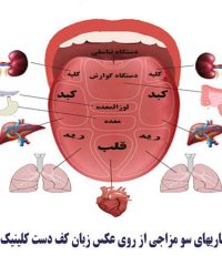 تشخیص بیماریهای سو مزاجی از روی عکس زبان کف دست کلینیک سعیدی اصفهان