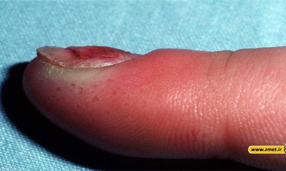 فلون چیست و چگونه موجب عفونت نوک انگشت میشود؟