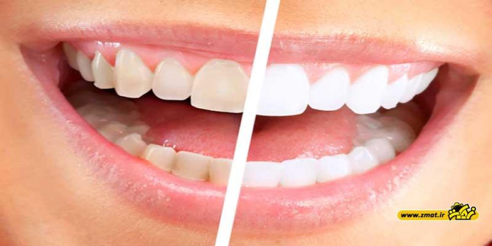 دلایل بدرنگی دندان ها چیست؟