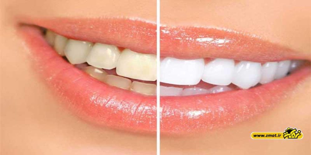 ۶ ماده غذایی ایجادکننده جرم دندان