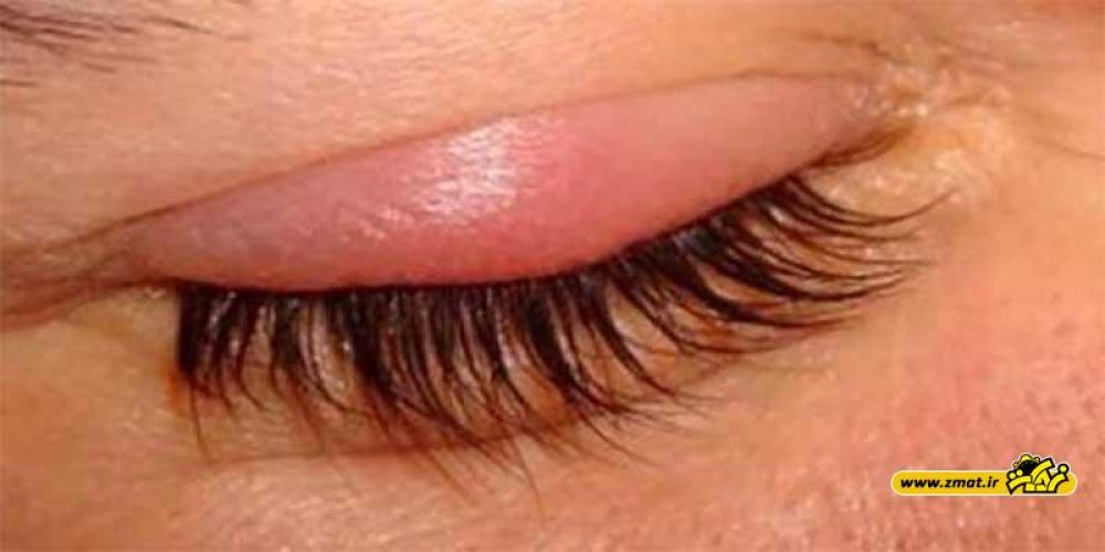 درمان گل مژه چشم با ۱۱ داروی خانگی