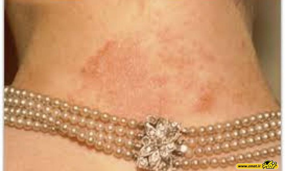 10 نکته درباره حساسیت پوستی به زیورآلات