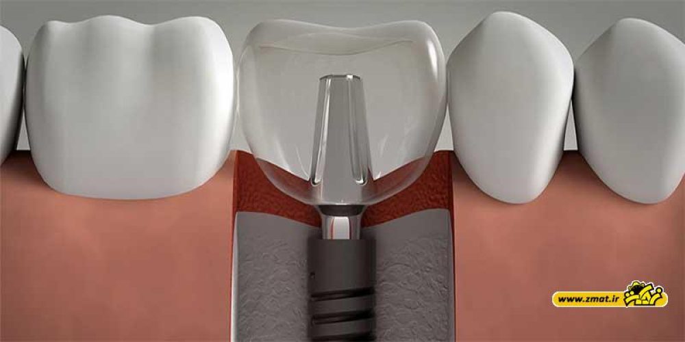ایمپلنت دندان چیست و انواع ایمپلنت کدام اند؟