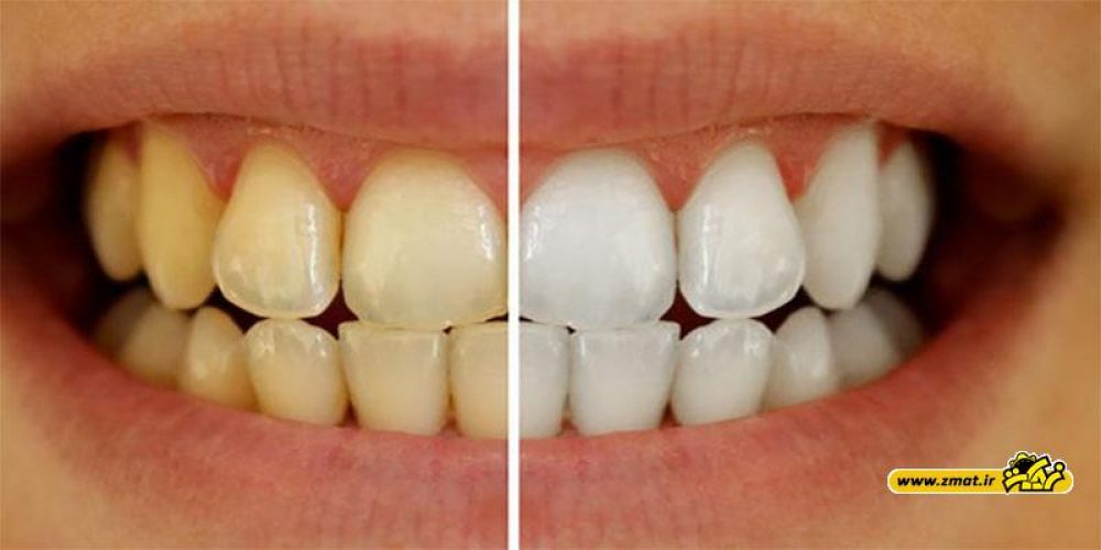 6 روش طبیعی سفید کردن دندان ها