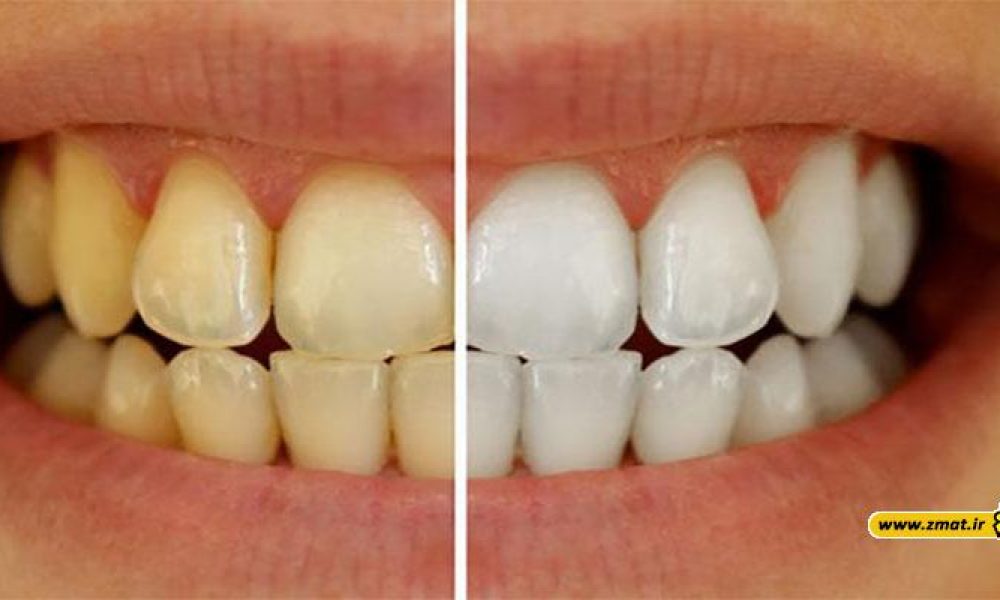6 روش طبیعی سفید کردن دندان ها