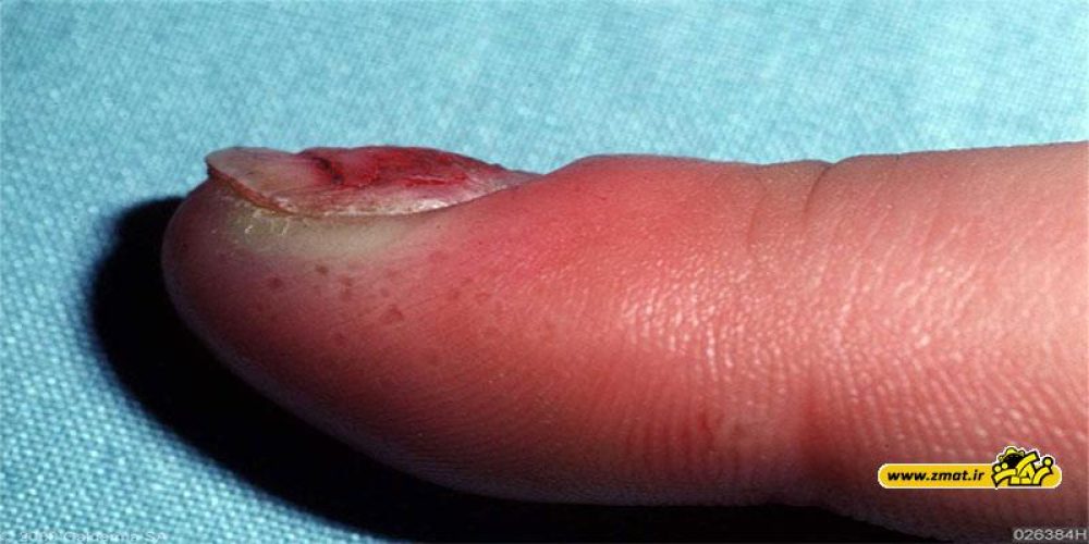 فلون چیست و چگونه موجب عفونت نوک انگشت میشود؟