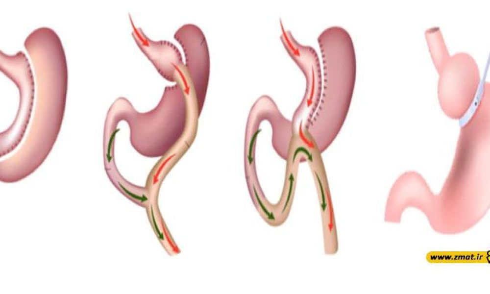 مضررات کوچک کردن معده