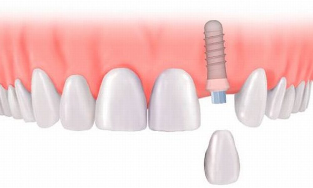 ایمپلنت (کاشت دندان) چیست؟