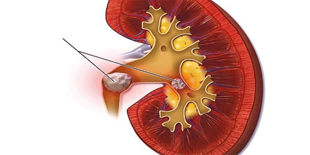درمان سنگ کلیه