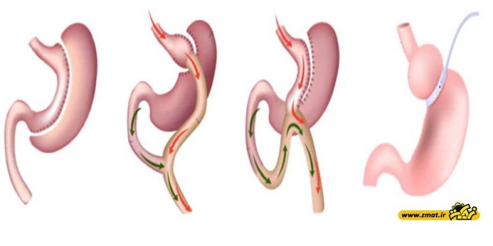 مضررات کوچک کردن معده