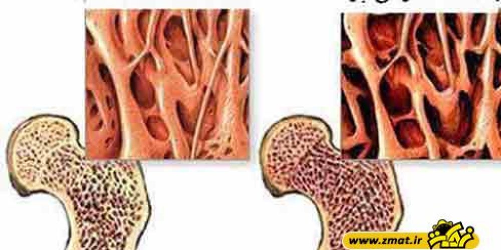 چرا پوکی استخوان در زنان بیشتر است؟
