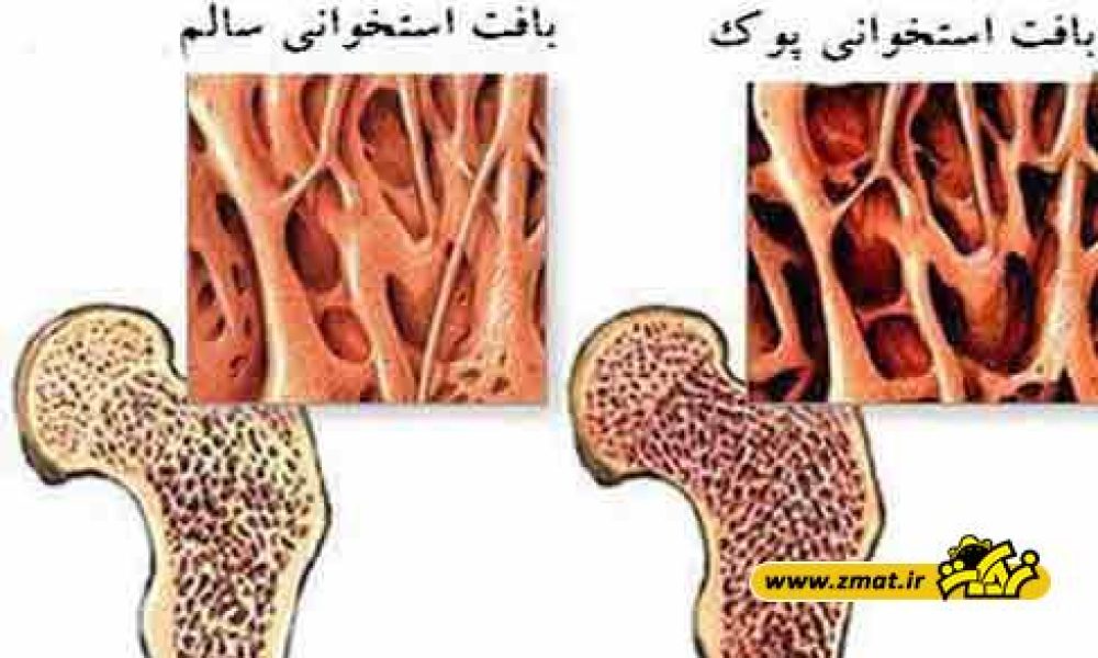 چرا پوکی استخوان در زنان بیشتر است؟