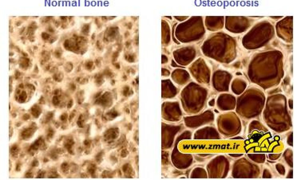 پوکی استخوان چیست؟