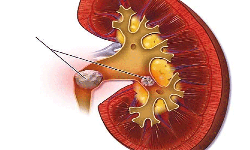 درمان سنگ کلیه