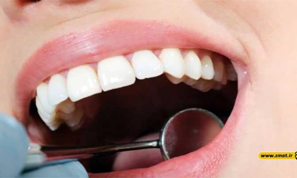 عوارض جانبی لمینت، کامپوزیت و روکش دندان